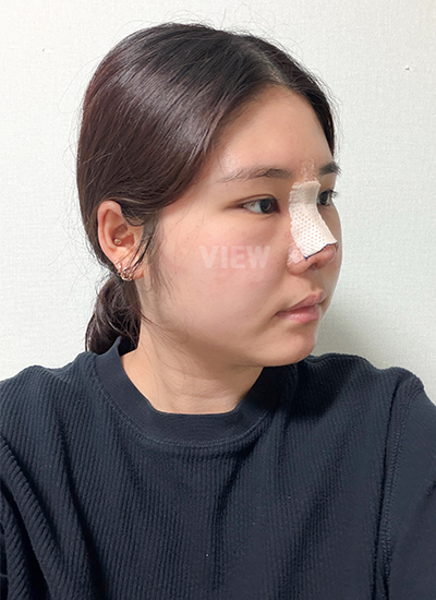 Nose surgery recovery