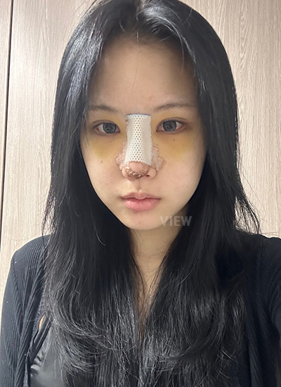 3 days after nose surgery in Korea