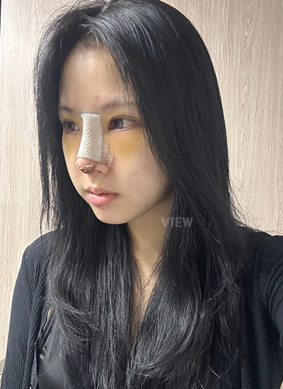 nose surgery in Korea
