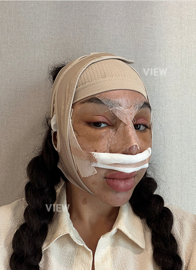 3 Days After Nose Surgery in Korea (Recovery)