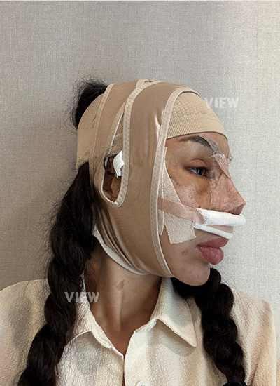 Post nose surgery recovery
