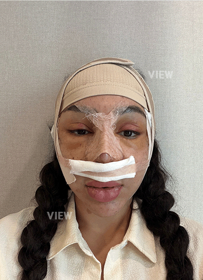 3 Days After Nose Surgery in Korea (Recovery)