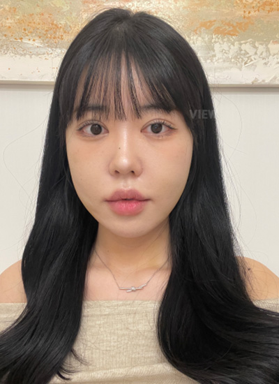 7 Days After Double Chin Liposuction Korea Recovery