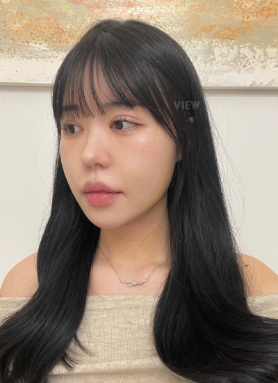7 Days After Double Chin Liposuction Korea Recovery