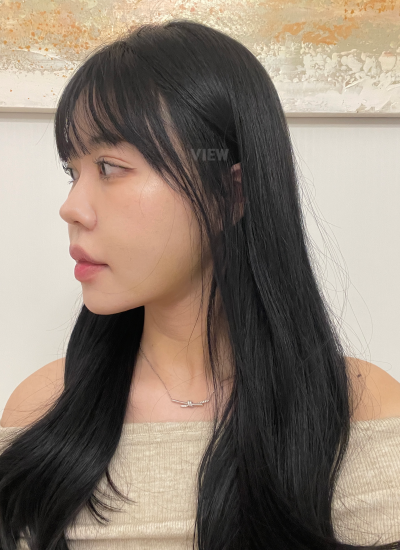 7 Days After Double Chin Liposuction Korea Recovery