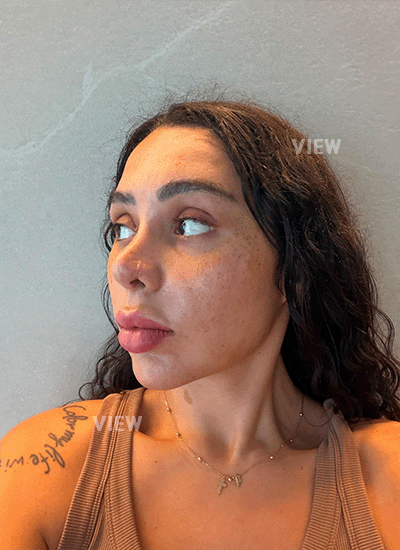 1 Week After Rhinoplasty in Korea: Early Recovery