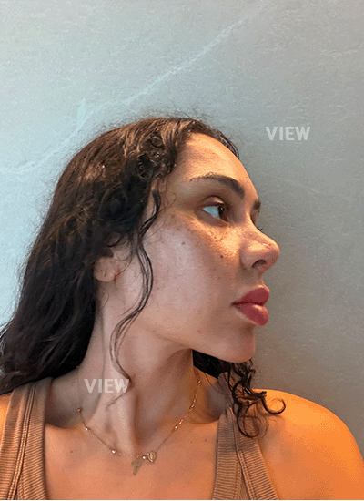 1 Week Post Plastic Surgery in Korea