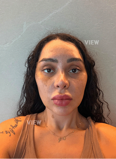 Only one week post-surgery from my rhinoplasty in Korea, and I'm genuinely surprised by how well I feel.