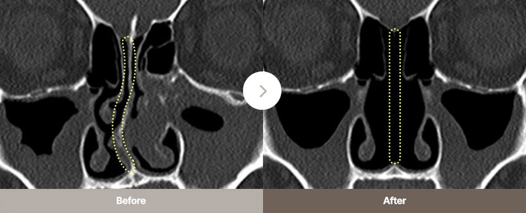 Functional Rhinoplasty 3D-CT Examination