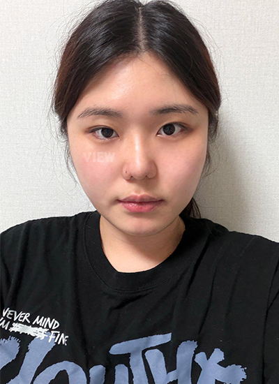 One Month After Rhinoplasty in Seoul