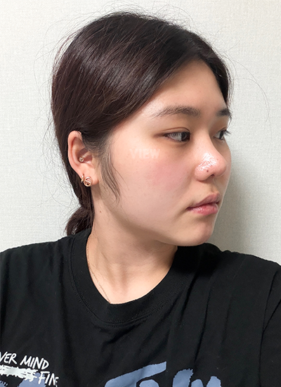 Bulbous nose surgery in Korea