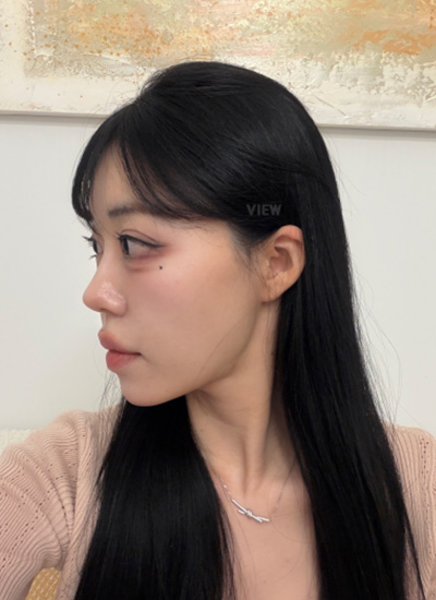 Before and after liposuction in Korea