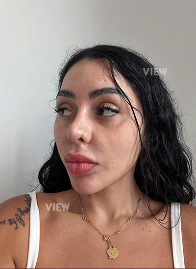 1 Month Rhinoplasty Recovery in Gangnam: Natural Results