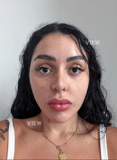 1 month after nose surgery in Korea