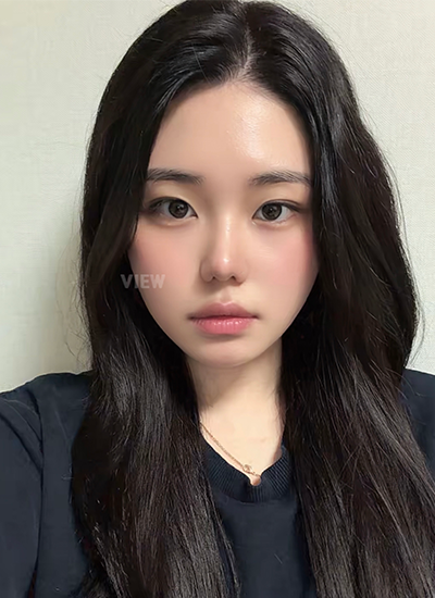 Two Months Post-Rhinoplasty