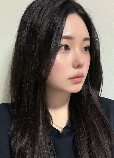 Starting from the two-month mark, I can really notice the swelling going down day by day
