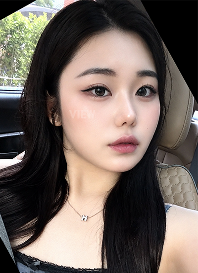 Three Months After Korean Rhinoplasty