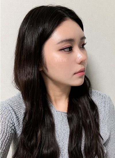 Nose surgery results in Korea