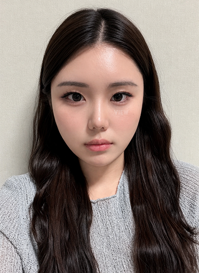 Four Months After Nose Surgery at View Plastic Surgery in Korea