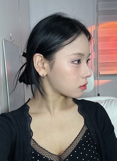 nose surgery before & after
