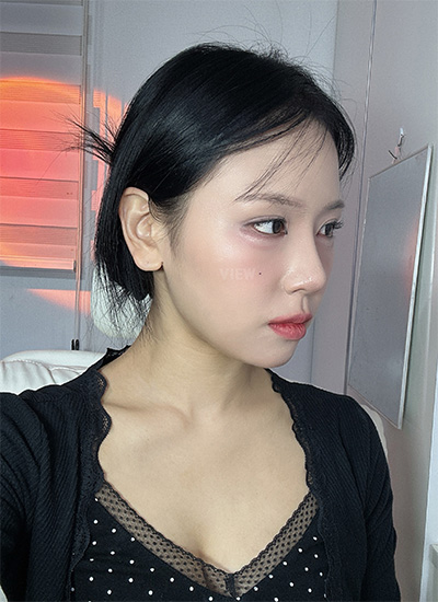 recovery after nose surgery in Korea