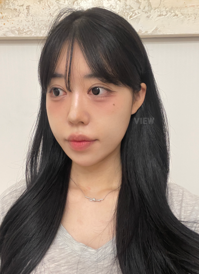 8 Months After Plastic Surgery at View Plastic Surgery in Korea