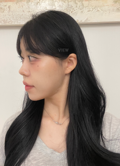 Result after face liposuction