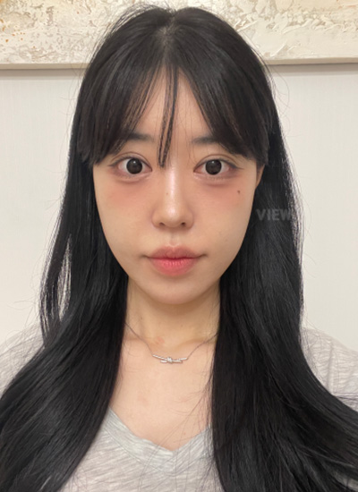 8 Months After Plastic Surgery at View Plastic Surgery in Korea