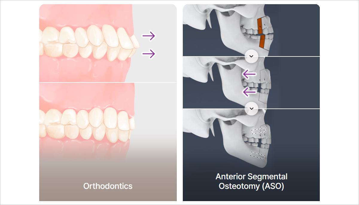 Orthodontics Anterior Segmental Osteotomy(ASO)