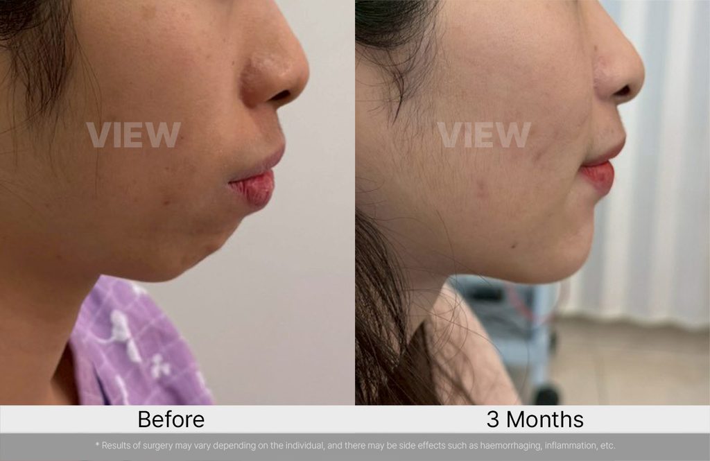 VIEW PLASTIC SURGERY ASO before after 01