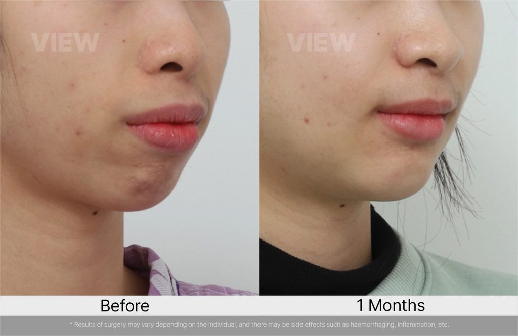 VIEW PLASTIC SURGERY ASO before after 03
