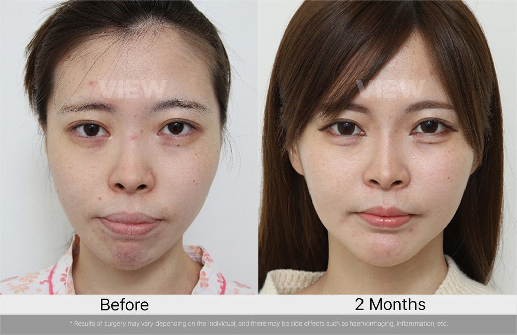VIEW PLASTIC SURGERY ASO before after 02