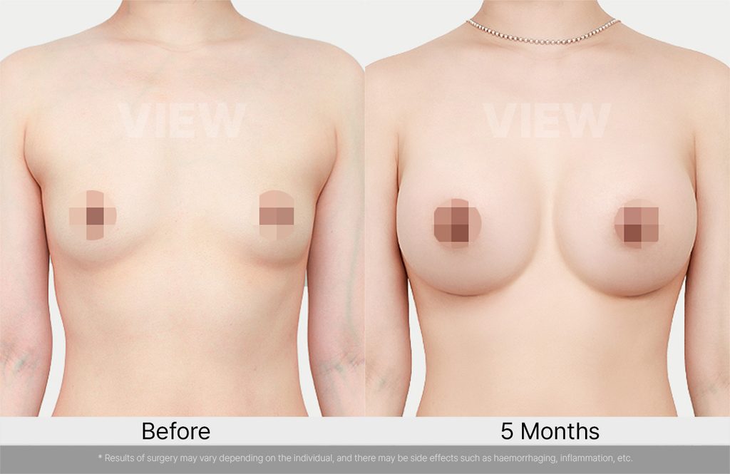 VIEW-PLASTIC-SURGERY-Breast-Surgery-before-after-01