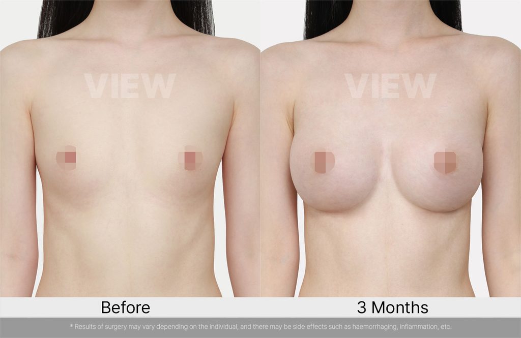 VIEW-PLASTIC-SURGERY-Breast-Surgery-before-after-02