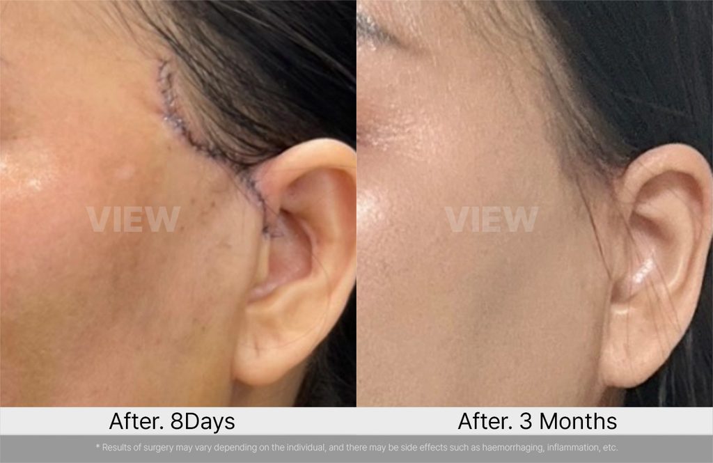 VIEW PLASTIC SURGERY Mini Facelift Incision Scars