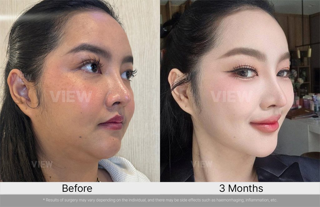 VIEW PLASTIC SURGERY Mini Facelift before after 01