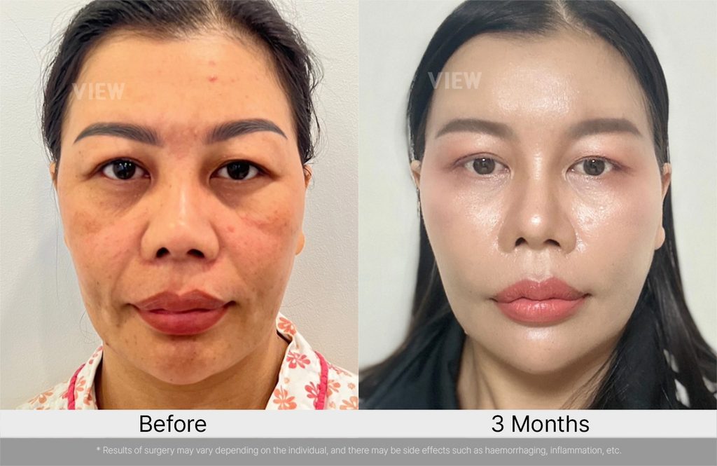 VIEW PLASTIC SURGERY Mini Facelift before after 02