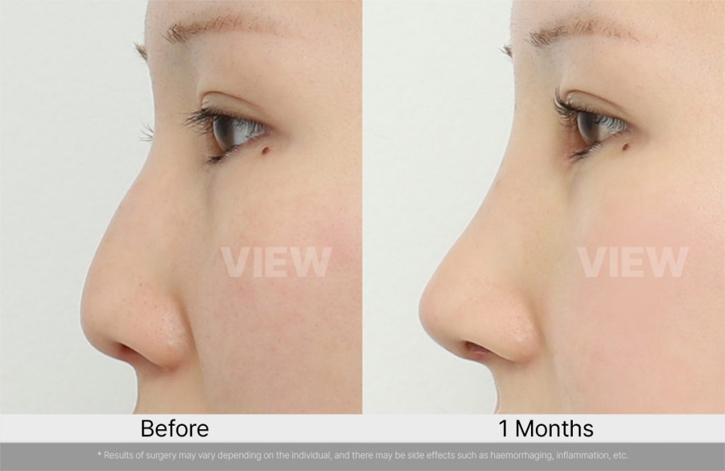 Low Nasal Bridge Self-Diagnosis: Finding Your Golden Ratio