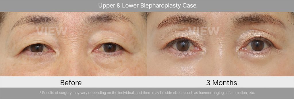 VIEW Plastic Suregery Upper Lower Blepharoplasty Case 01