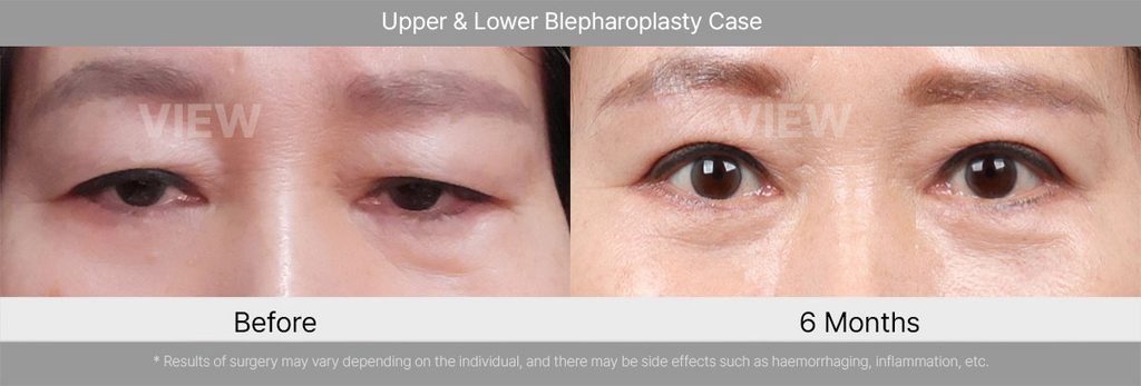 VIEW Plastic Suregery Upper Lower Blepharoplasty Case 02