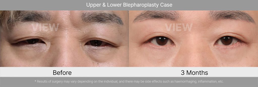 VIEW Plastic Suregery Upper Lower Blepharoplasty Case 03