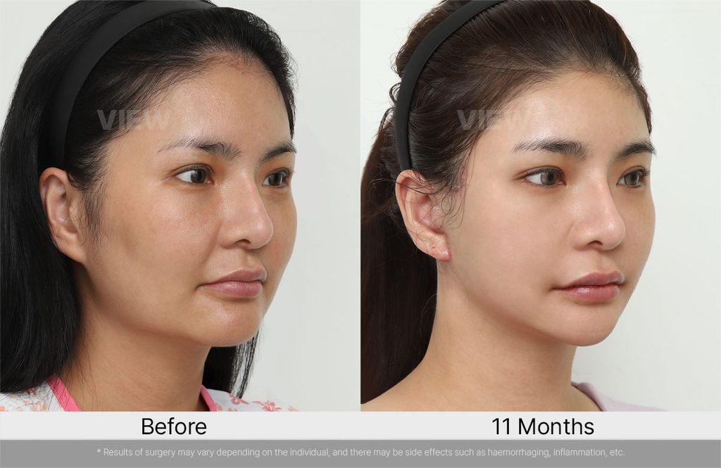 VIEW Plastic Surgery Full Facelift Before After 01