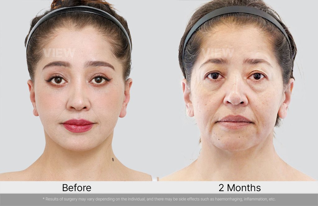 VIEW Plastic Surgery Full Facelift Before After 02