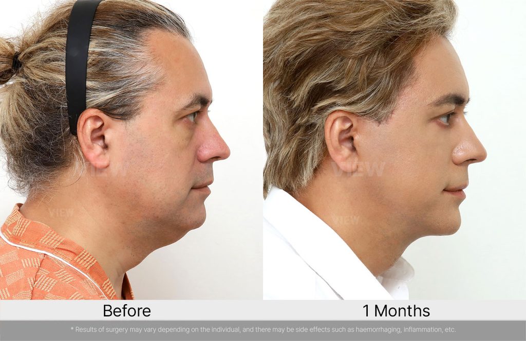 VIEW Plastic Surgery Full Facelift Before After 03
