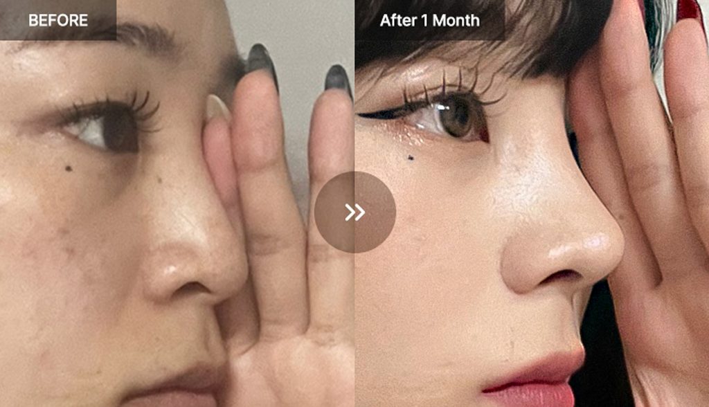 VIEW Plastic Surgery rhinoplasty before and after photos 01