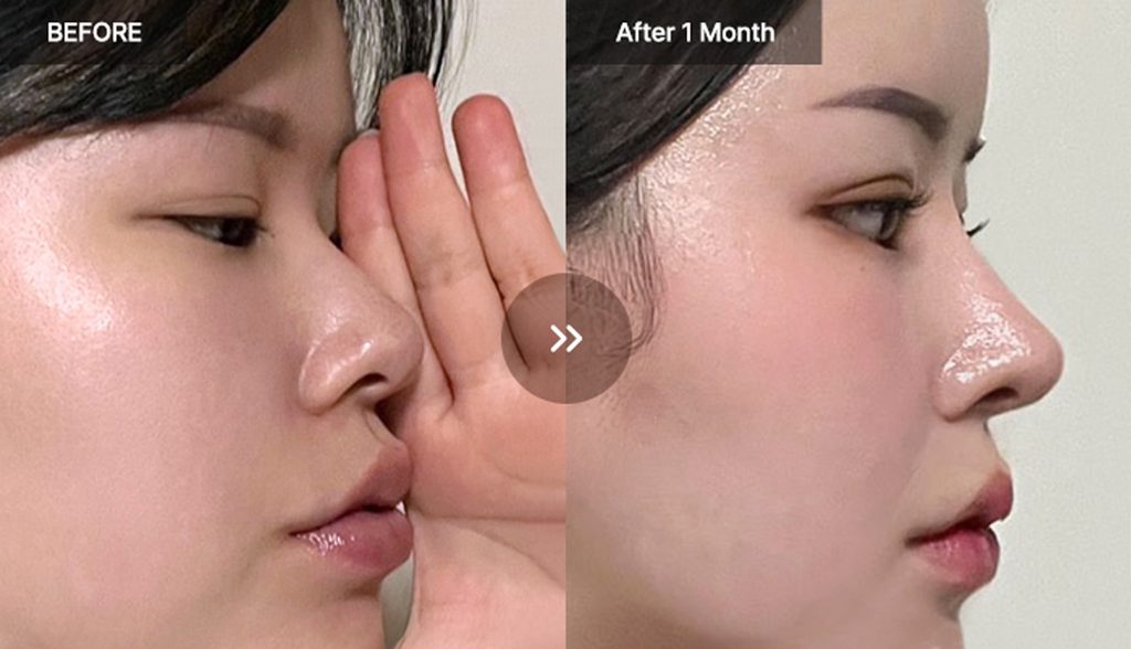 VIEW Plastic Surgery rhinoplasty before and after photos 02