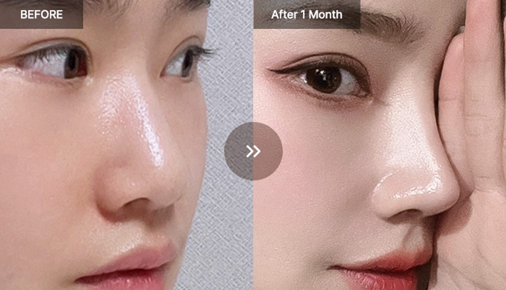 VIEW Plastic Surgery rhinoplasty before and after photos 03