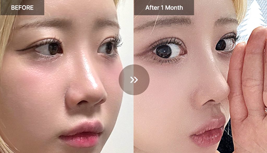 VIEW Plastic Surgery rhinoplasty before and after photos 04
