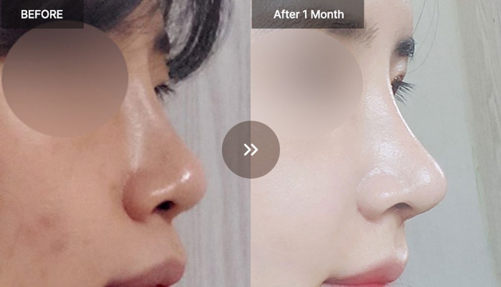 VIEW Plastic Surgery rhinoplasty before and after photos 05