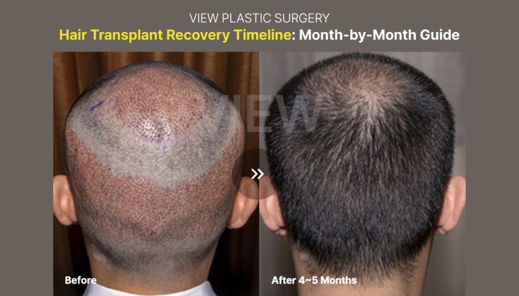 Hair Transplant Recovery Timeline: Month-by-Month Guide